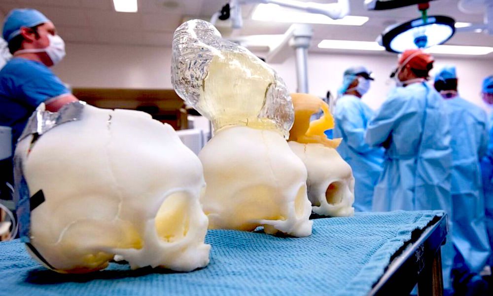 Child Born with Brain Outside of Skull Saved by 3D Printing