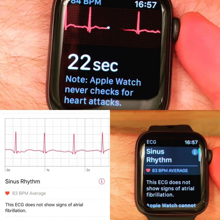 Apple Watch Electrocardiogram Ecg 5 Things You Need To Know